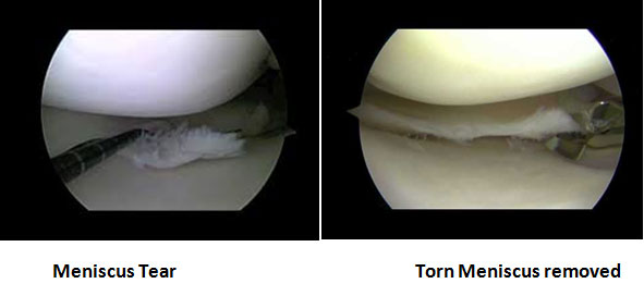 Meniscectomy/Meniscus Repair Mark Ganjianpour M.D