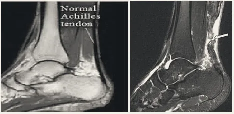 MRI of the ankle showing a normal Achilles tendon (left) and an injured tendon (right).