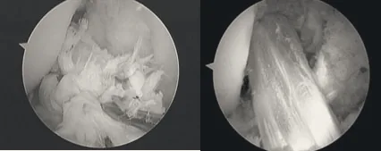 Arthroscopic views inside the knee.
