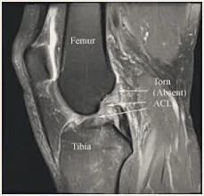 Sagittal MRI of the knee showing a torn ACL.