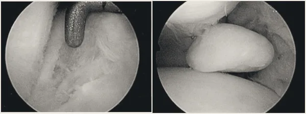 Arthroscopic views inside the ankle joint.