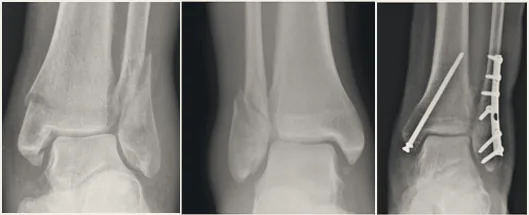 X-rays of the ankle, including fixation with plate and screws.