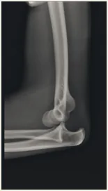 Lateral X-ray of the elbow.