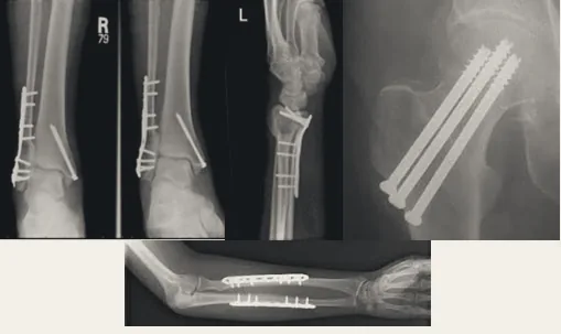 X-rays showing fracture fixation with plates and screws.