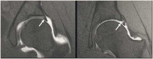 MRI arthrogram images of the hip.