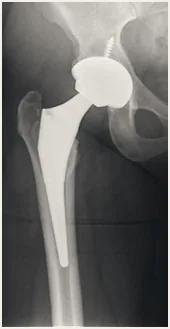 X-ray following hip replacement.