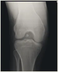 X-ray of the knee.
