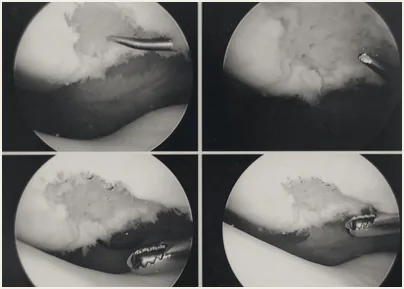 Arthroscopic views inside the knee joint.