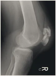 Lateral X-ray of the knee.