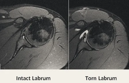 MRI comparison: intact labrum (left) and torn labrum (right).