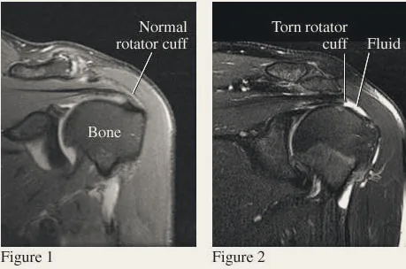 MRI comparison: normal rotator cuff (left) and torn rotator cuff (right).