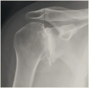 X-ray of an arthritic shoulder joint.