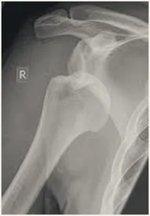 X-ray of the shoulder.