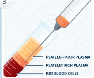 prp-injection3