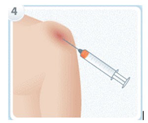prp-injection4