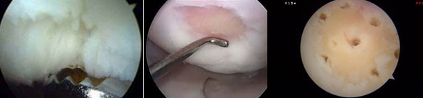 Chondroplasty / Microfracture Mark Ganjianpour M.D